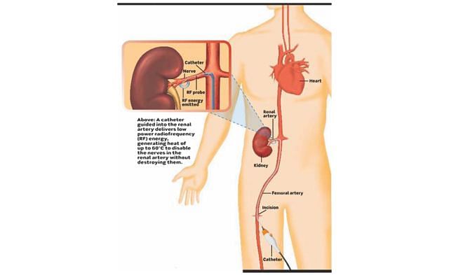 Renal Denervation To Treat Resistant Hypertension The Daily Star