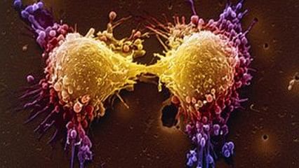 Prostate cancer is the most common cancer in UK men. Photo: BBC