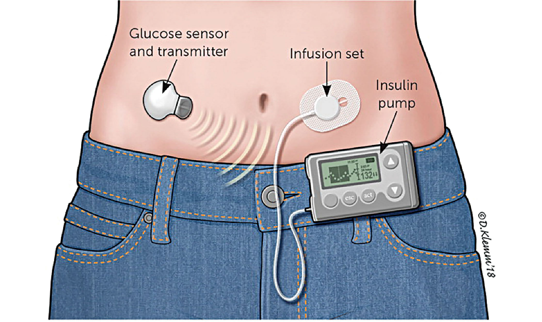 Insulin Pump - a beacon of hope for children with Type 1 Diabetes