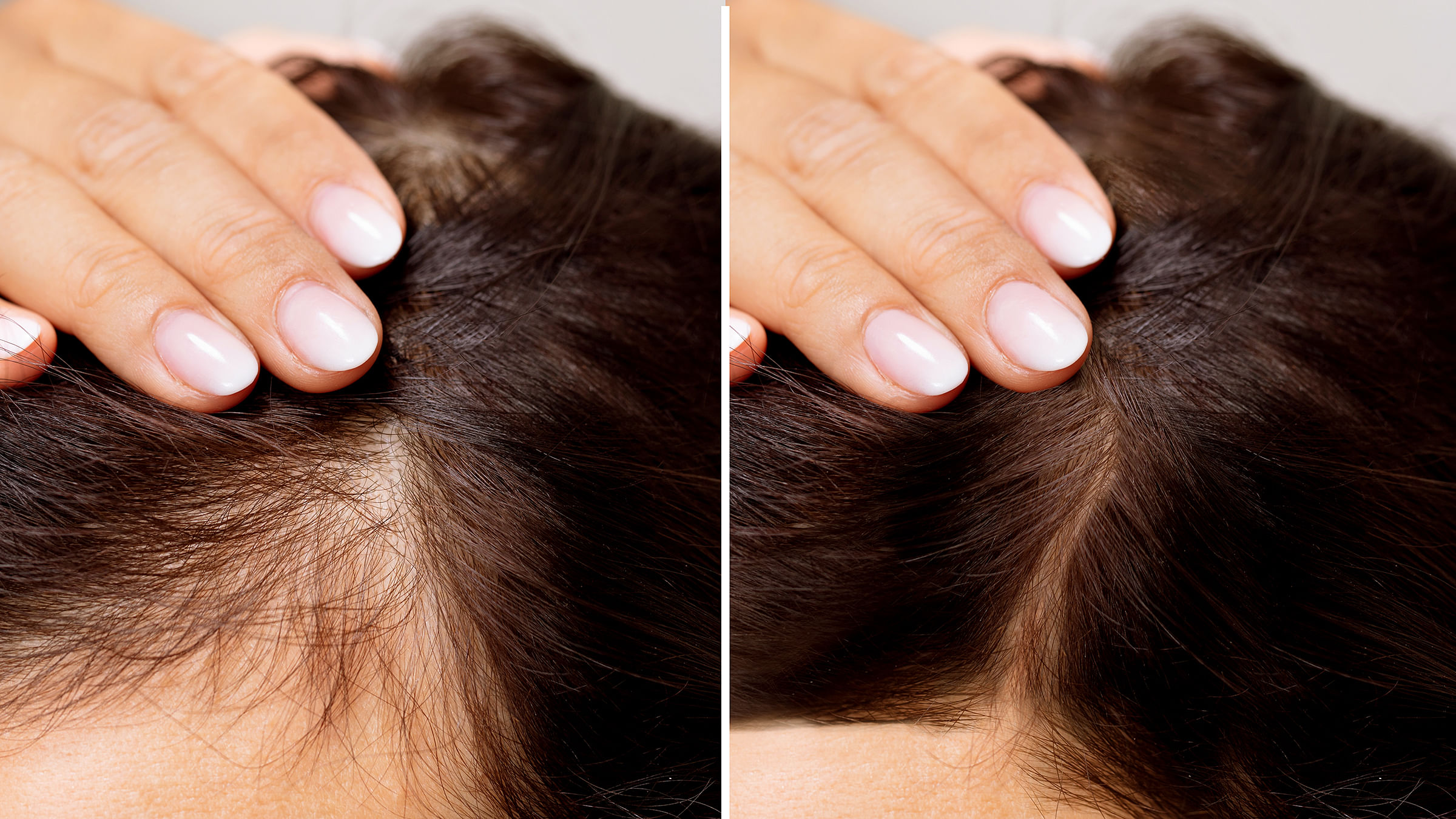 Top 5 home remedies that can help reduce hair loss | The Daily Star