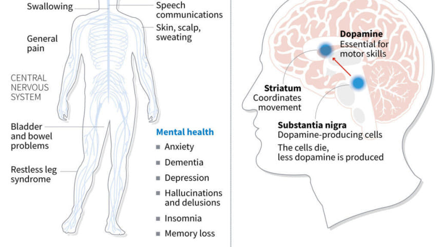 Parkinson's disease.jpg