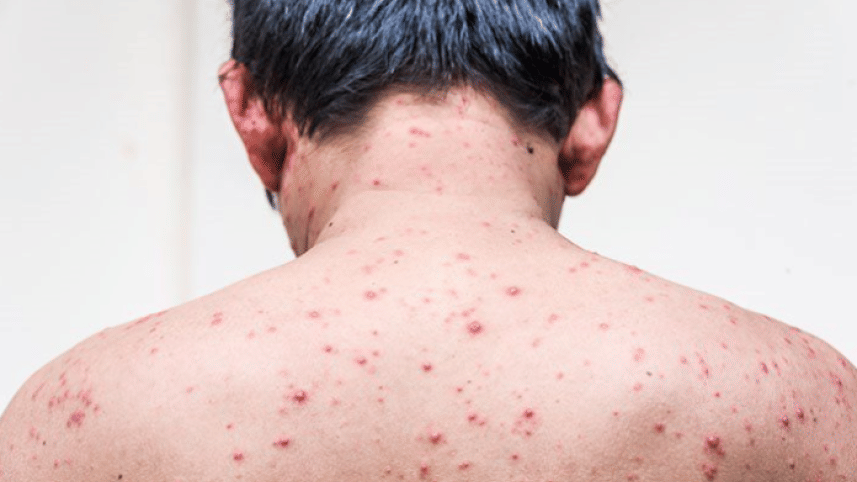 chickenpox-web.png