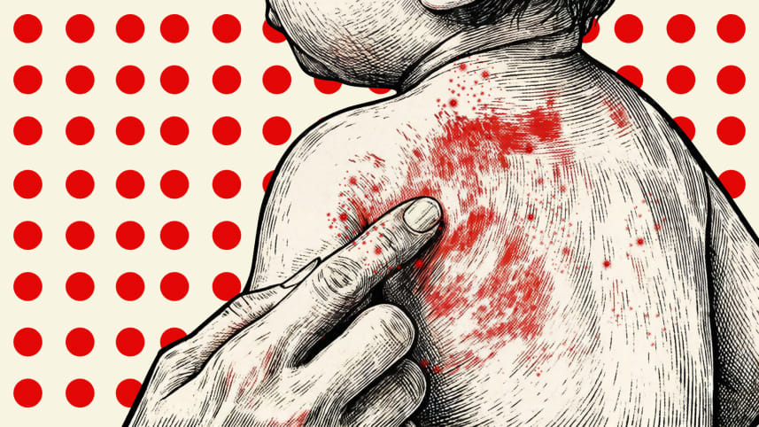 Bangladesh measles vaccine crisis investigation