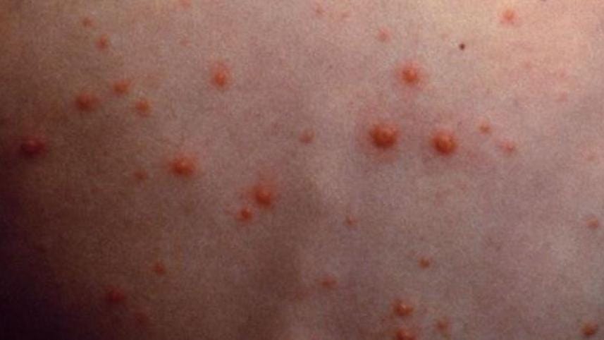Chickenpox disease