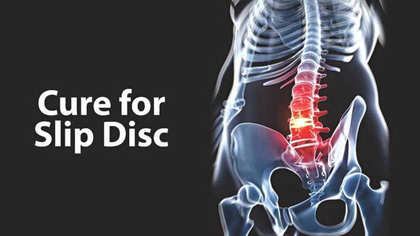 Vertebral disc prolapse