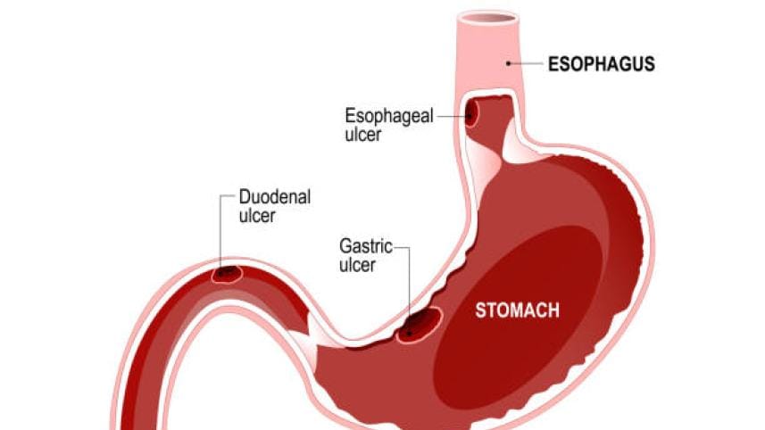 stomach_ulcer.jpg