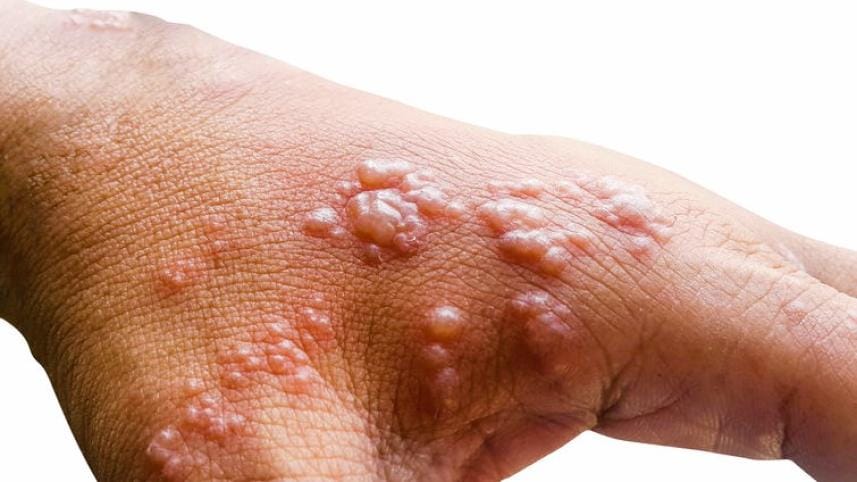 monkeypox outbreak India