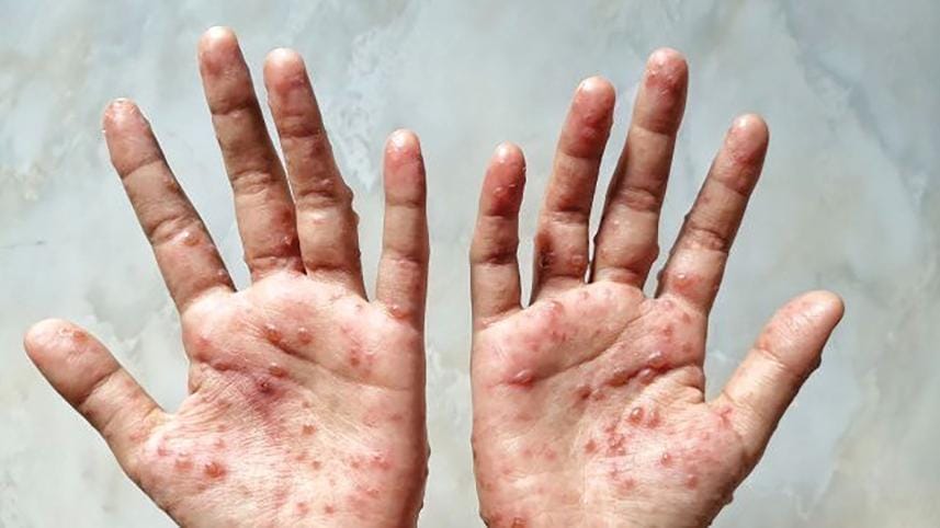 Monkeypox Virus