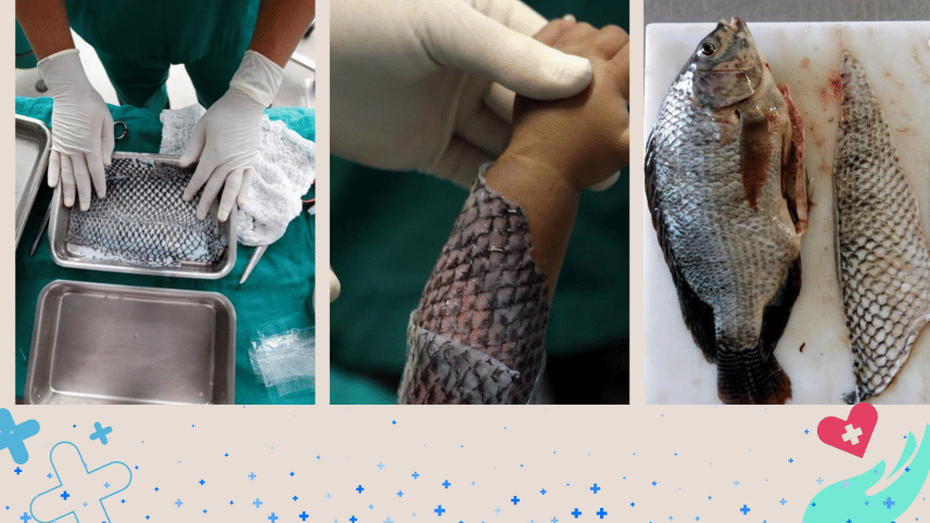 Healing burns! The remarkable benefits of tilapia skin