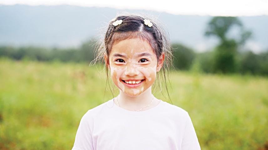 vitiligo-in-children.jpg