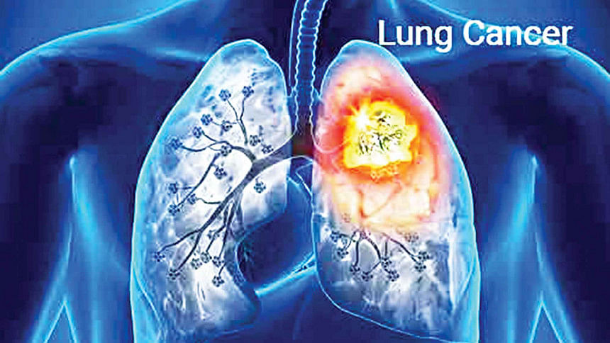 All you need to know about lung cancer | The Daily Star