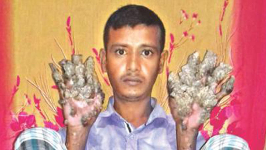Bangladesh tree-man Bangladesh tree-man
