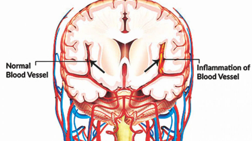 Cerebral vasculitis Cerebral vasculitis