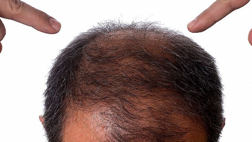 Drug to cure bald hair is here, scientists claim A cure for Alopecia or baldness has been discovered by scientists at Concert Pharmaceuticals, a U.S. based pharmaceutical company.