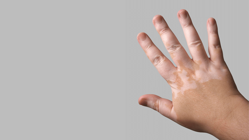 Photo of a hand with vitiligo
