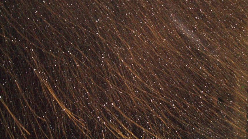 Tips to cure dandruff this winter Tips to cure dandruff this winter