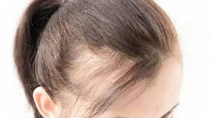 Receding Hairline Receding Hairline