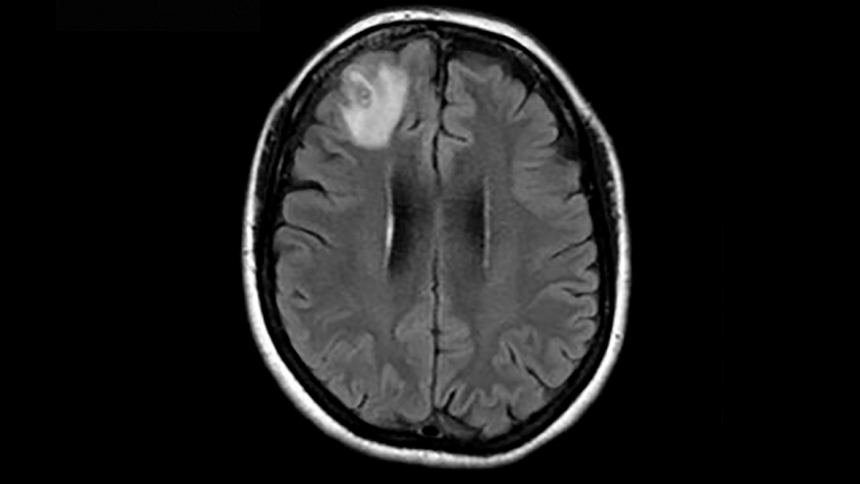 Australian doctors find a live parasitic worm in woman's brain