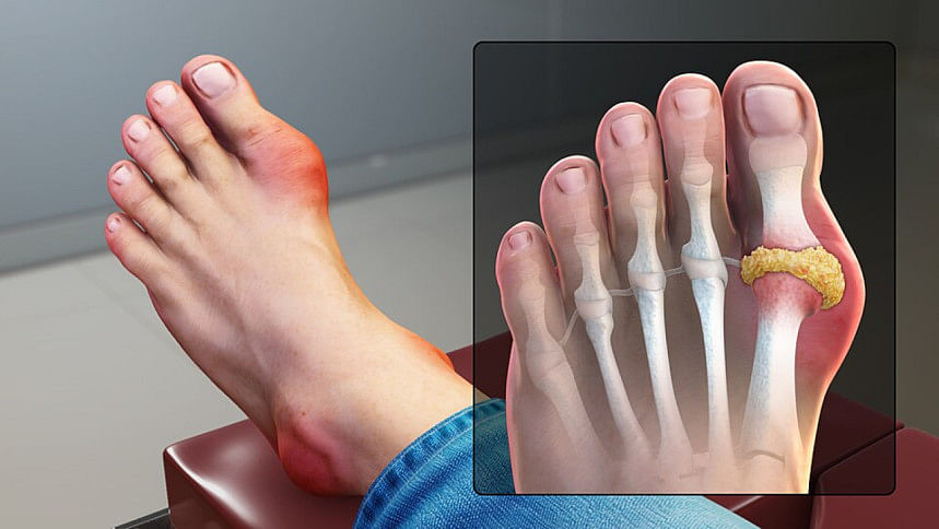 tips for gout patients eating red meat on eid tips for gout patients eating red meat on eid