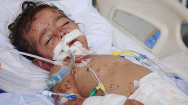 meningitis-death.jpg