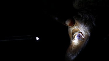 Cataract surgery.png