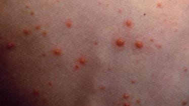 Chickenpox disease