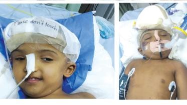 One of the conjoined twins Rabeya