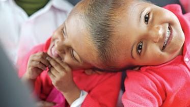 bangladeshi twins surgery