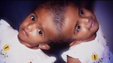 Conjoined Baby Rokeya and Rabeya