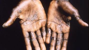 Monkeypox: Screening to start at airports, land ports