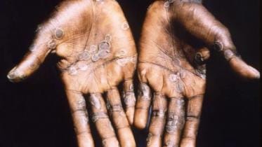 monkeypox-web.jpg