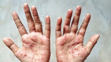 Monkeypox Virus