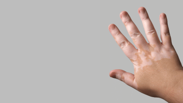 vitiligo_thumbnail.png