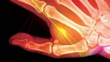 Learning about rheumatoid arthritis 