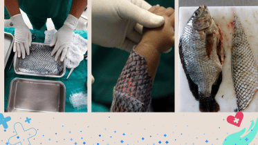 Healing burns! The remarkable benefits of tilapia skin
