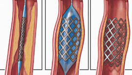 Cardiac stent prices cut by up to 46%