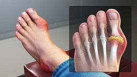tips for gout patients eating red meat on eid