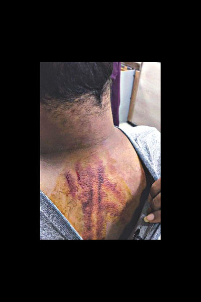 Injury marks on Shaer Reaz's back Injury marks on Shaer Reaz's back