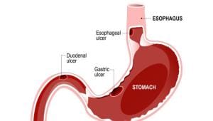 stomach_ulcer.jpg