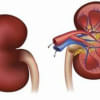 kidney decease kidney decease