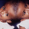 Conjoined Baby Rokeya and Rabeya Conjoined Baby Rokeya and Rabeya