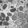 Kerala reports India’s first monkeypox-related death monkeypox death in India