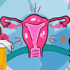 Representative illustration of PCOS