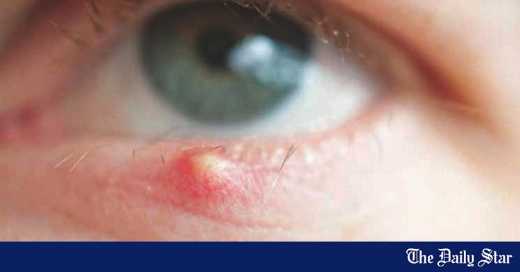 Signs & symptoms of stye | The Daily Star