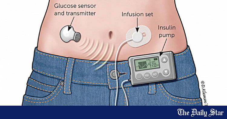 Insulin Pump - a beacon of hope for children with Type 1 Diabetes | The ...