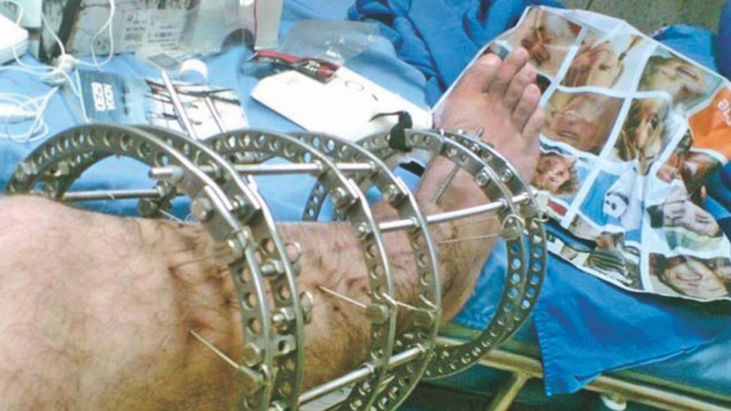 Limb lengthening Orthopaedic surgical focus The Daily Star