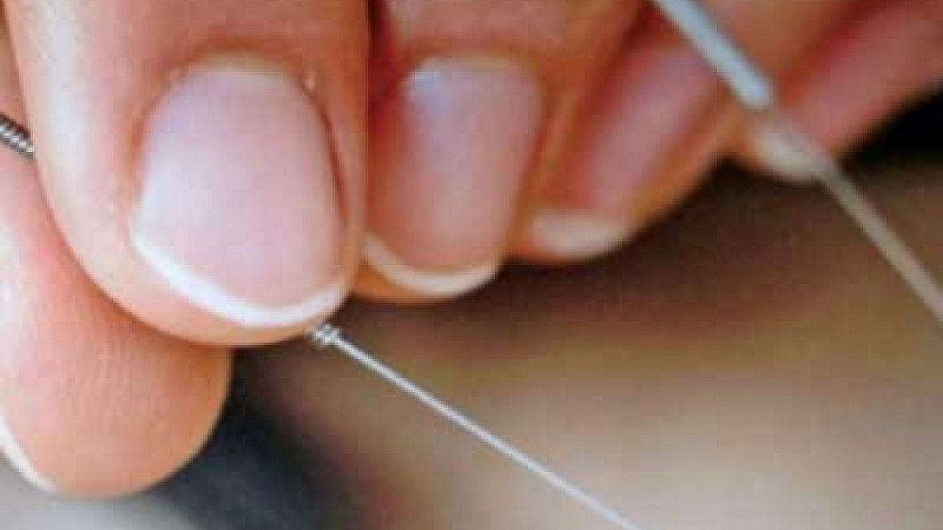 Myriad benefits of acupuncture The Daily Star