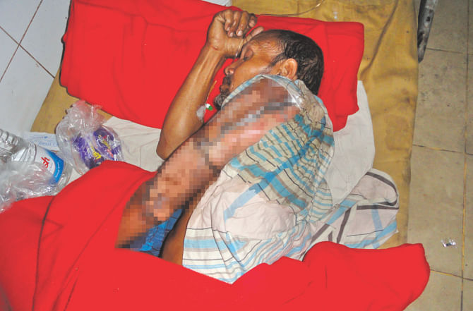 Abul Kalam, a truck helper, had his upper arm scalded in a petrol bomb attack on his vehicle in Birganj upazila, Dinajpur yesterday, the fifth day of the BNP-led indefinite countrywide blockade. Photo: Star, Banglar Chokh