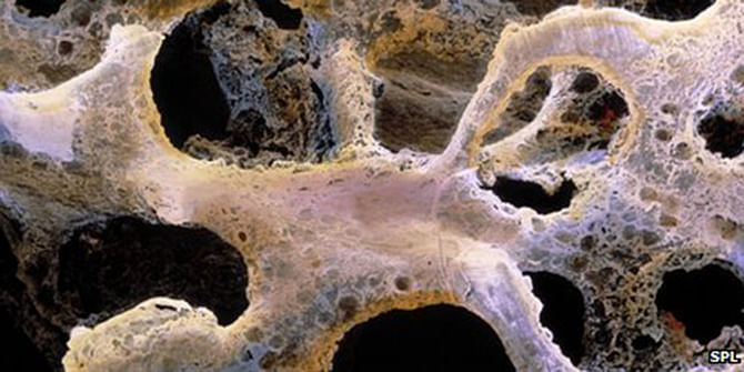A bone with osteoporosis Scientists hope their findings could help to treat common forms of osteoporosis. This photo is taken from BBC.