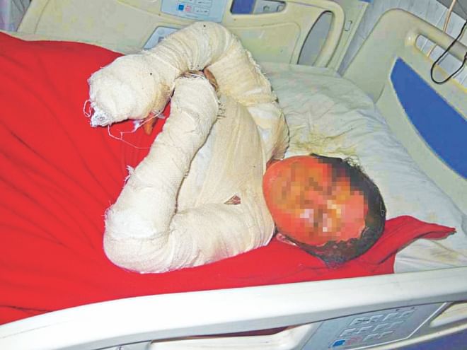 Tasiran Bewa with 96 percent burns at a Rangpur hospital. She later died while being taken to DMCH. Photo: Star